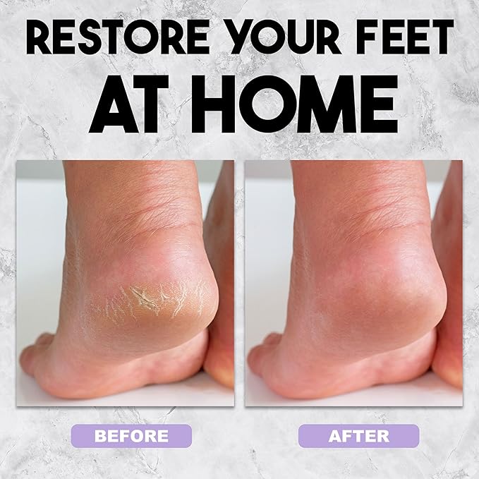 Expressions Callus Remover – Foot File Pedicure Tool with No‑Mess Collection Compartment